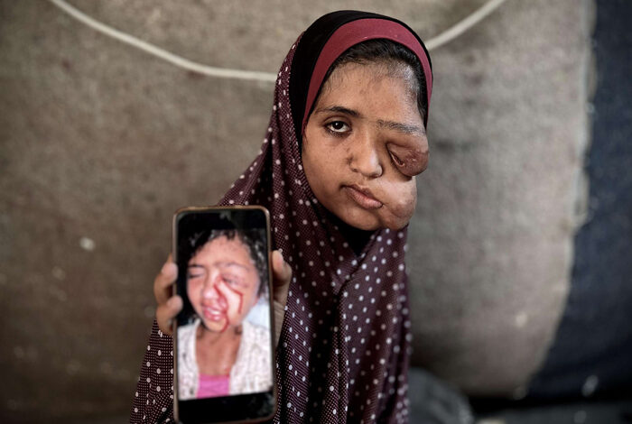 صورة مأساة فتاة فلسطينية تجسد وحشية العدوان على المدنيين والمرضى في غزة